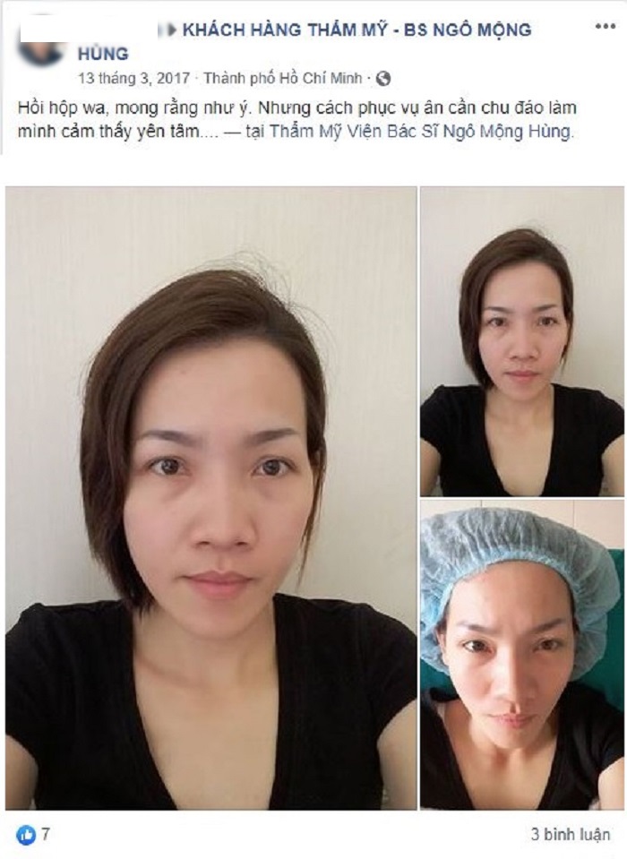 Cắt mí mắt