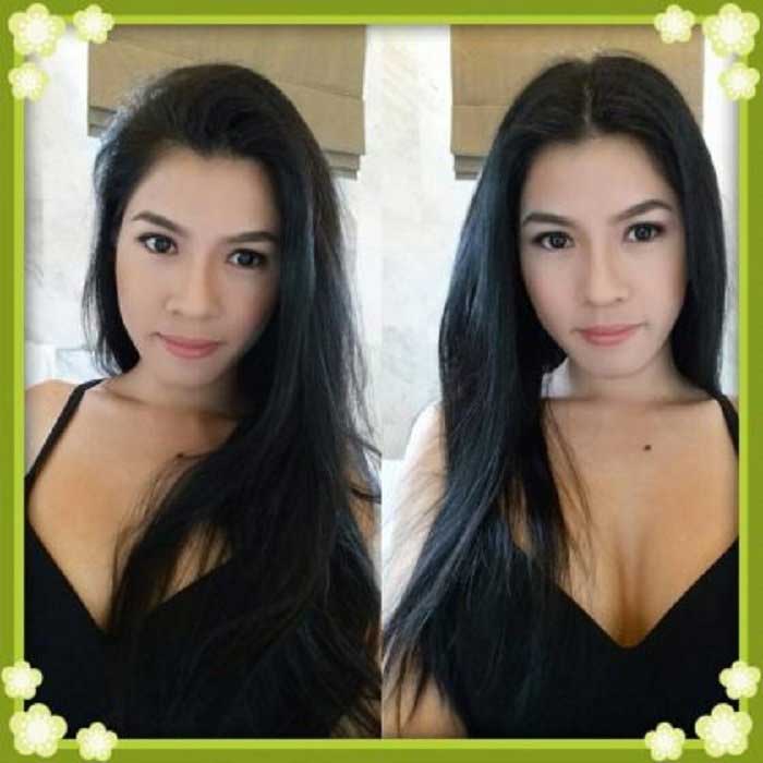 Lấy mỡ má