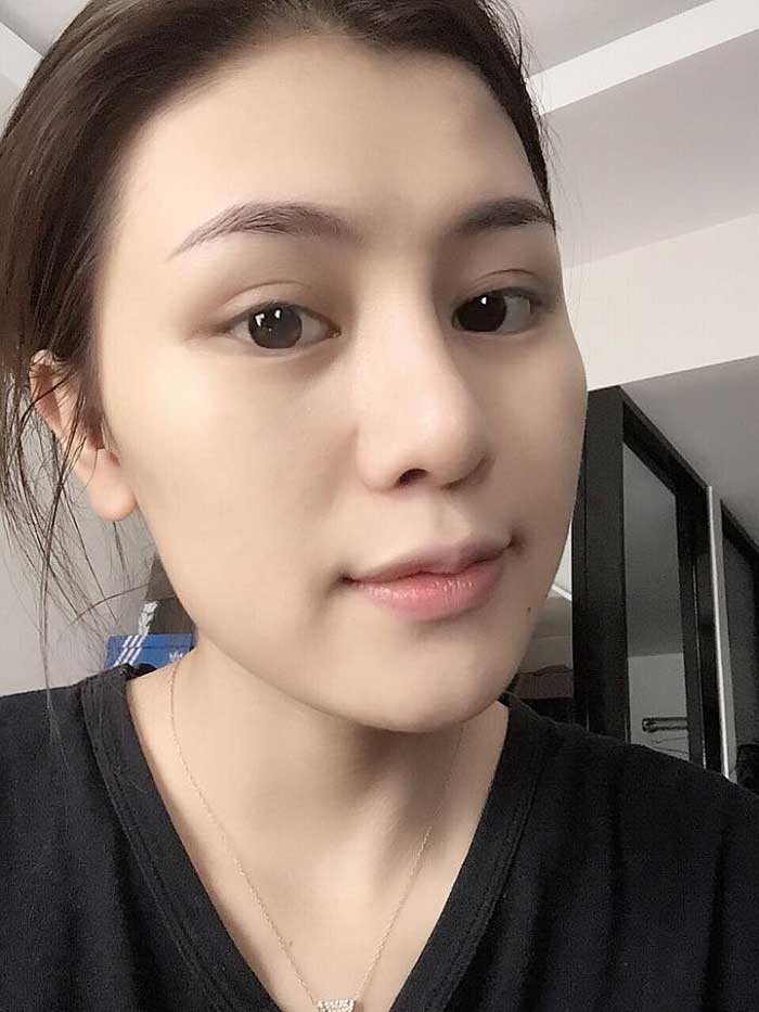 Nâng mũi S Line Nâng mũi S Line