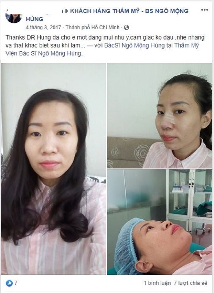 Nâng mũi Hàn Quốc