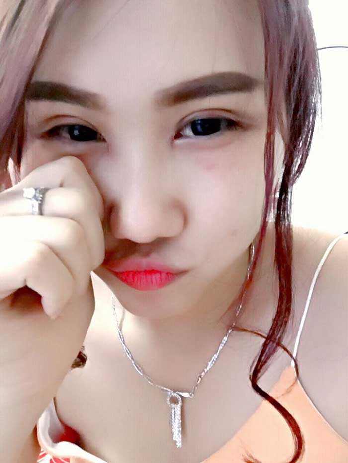 Bấm mí Hàn Quốc