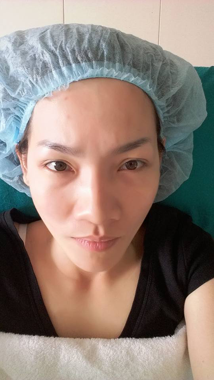 Cắt mí mắt