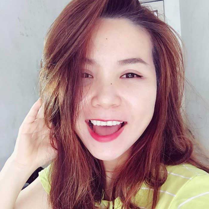 Cắt mí mắt