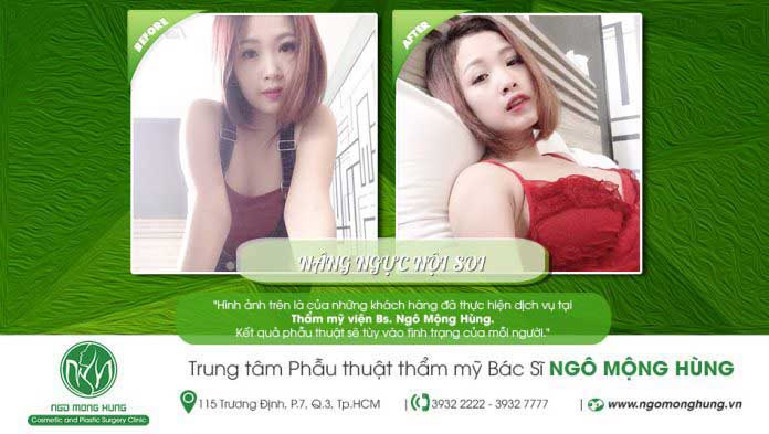 Nâng ngực nội soi