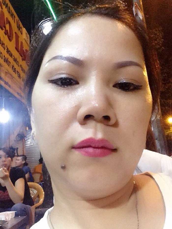 Cắt mí mắt
