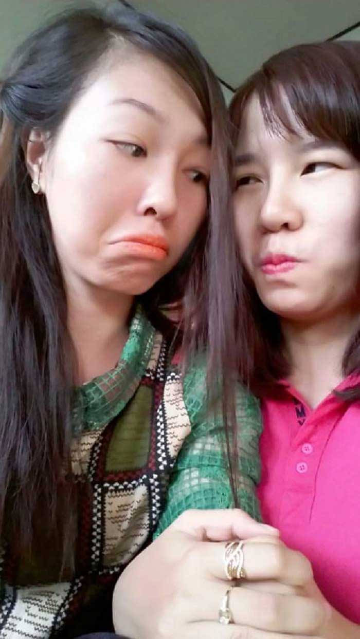 Nâng mũi bọc sụn