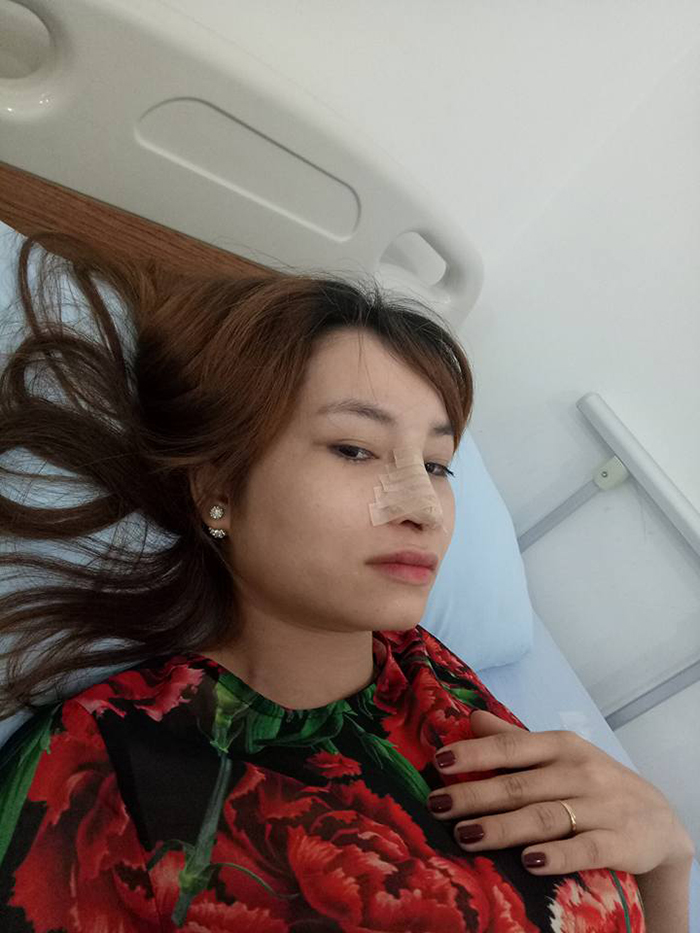 Nâng mũi bọc sụn