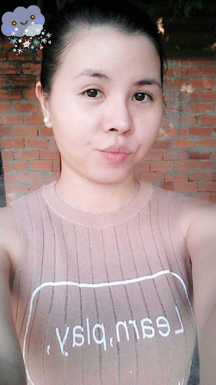 Nâng mũi bọc sụn Nâng mũi bọc sụn