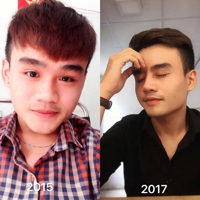 Nâng mũi bọc sụn