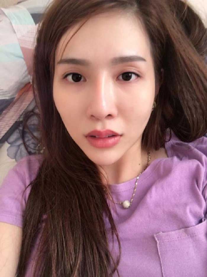 Nâng mũi Hàn Quốc