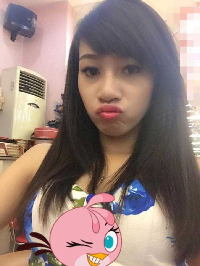 Nâng mũi bọc sụn