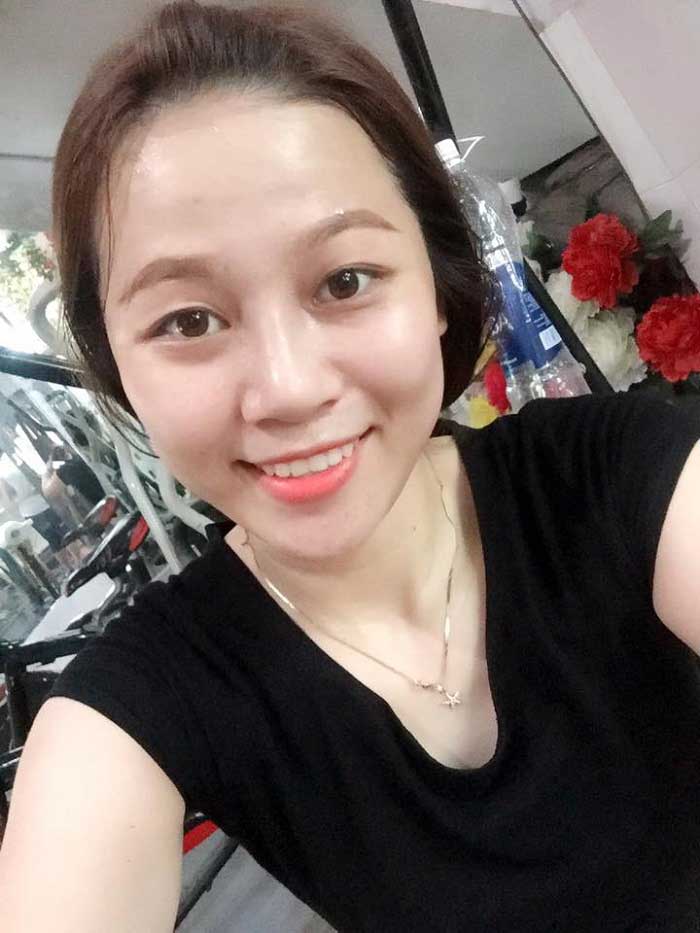 Nâng mũi bọc sụn