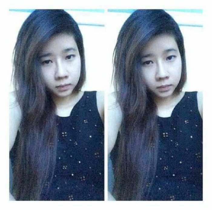 Nâng mũi bọc sụn
