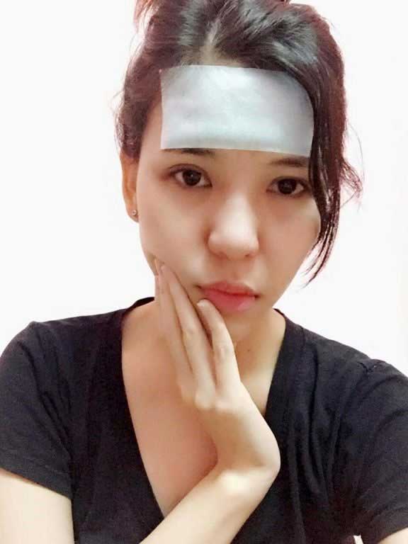 Bấm mí Hàn Quốc