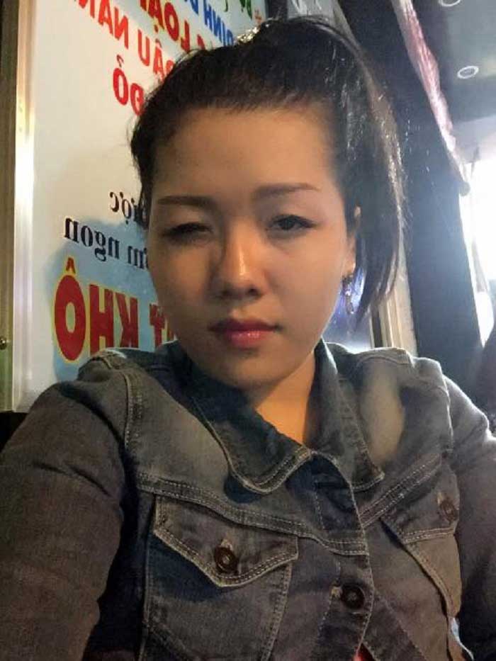 Cắt mí mắt