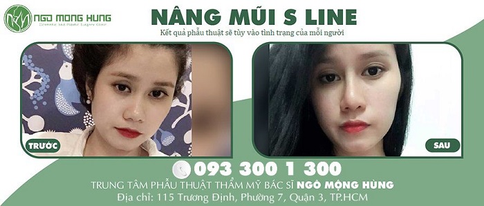 Hot girl giống Trương Quỳnh Anh như “hai giọt nước” nhờ nâng mũi S line