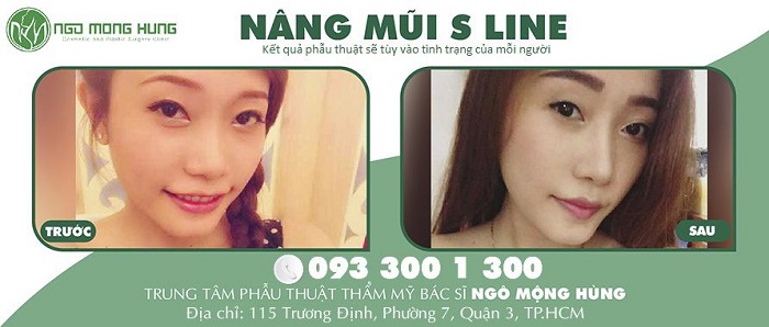 Phương Thảo: "Nếu bạn muốn mũi đẹp, đừng ngại nâng mũi!"