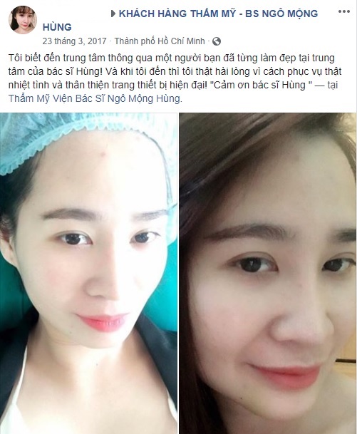 Độn cằm