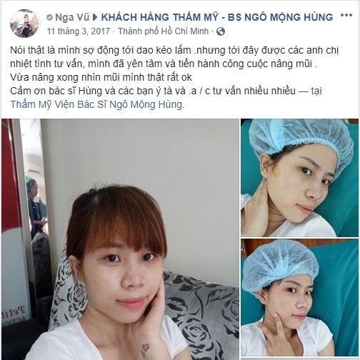 Nâng mũi bọc sụn