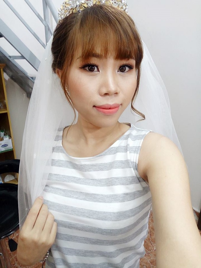 Nâng mũi bọc sụn