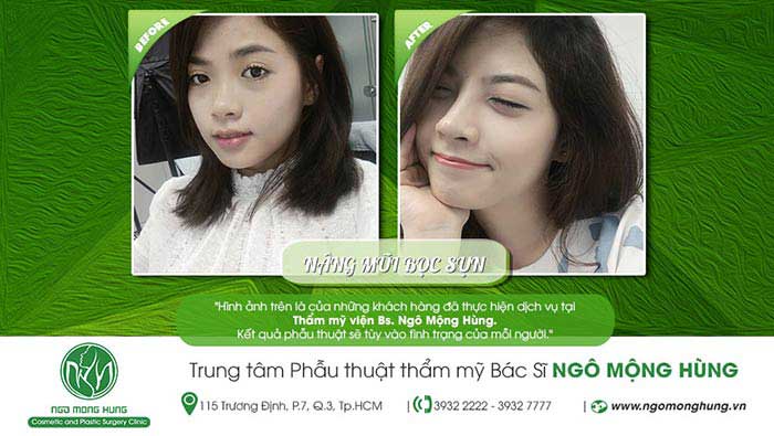 Nâng mũi bọc sụn