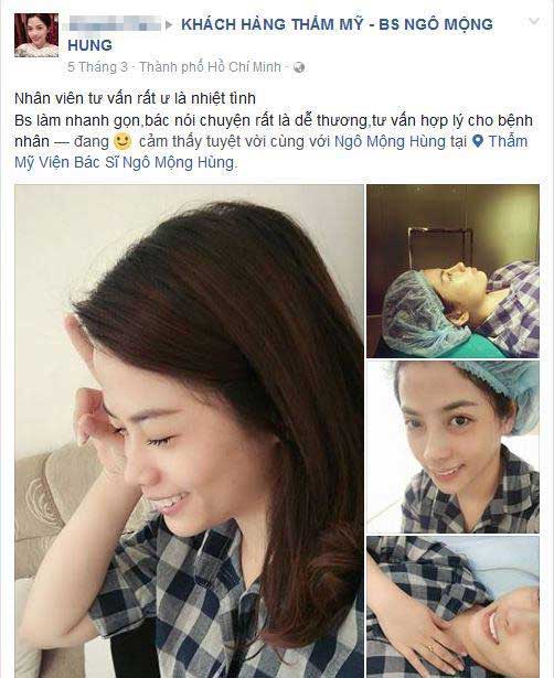 Nâng mũi bọc sụn