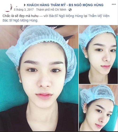 Cắt mí mắt