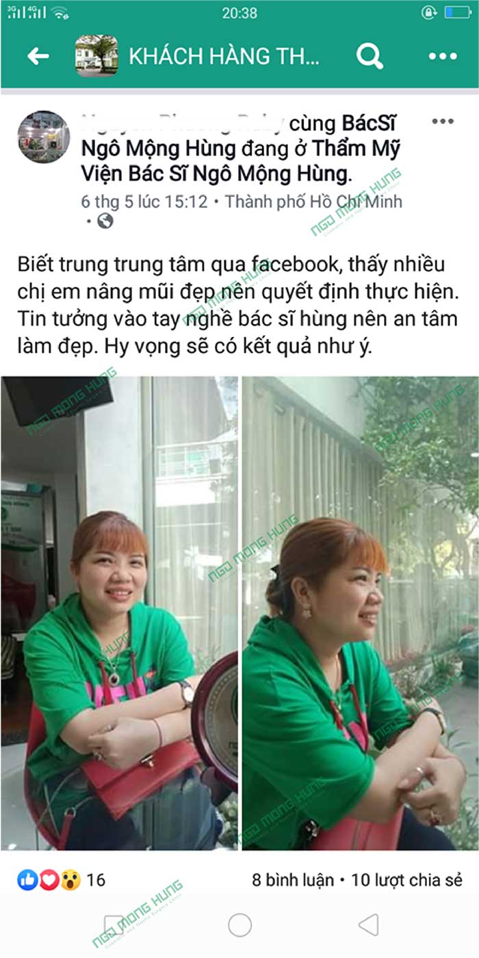 Hình ảnh nâng mũi Hàn Quốc
