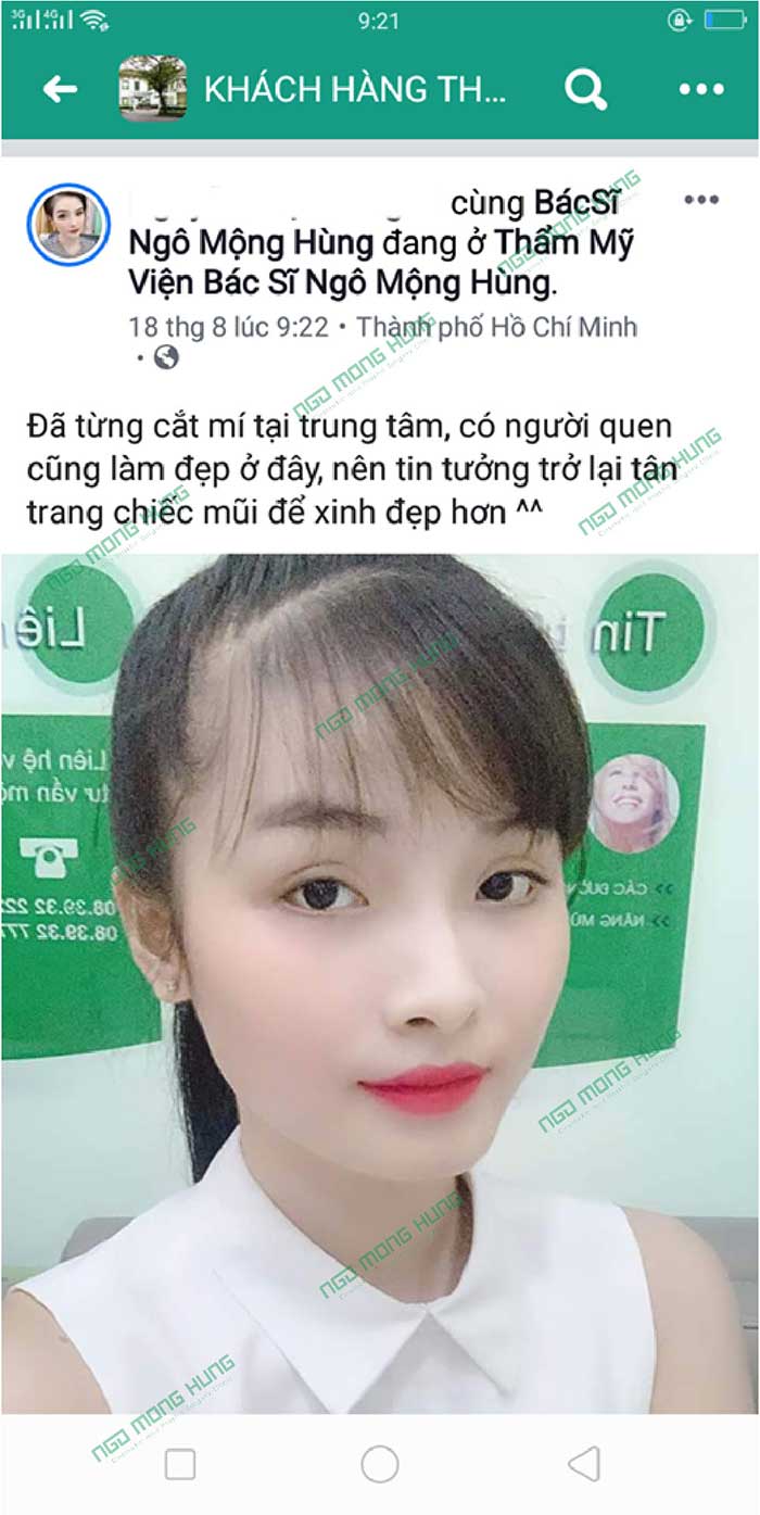 Cây nâng mũi Hàn Quốc