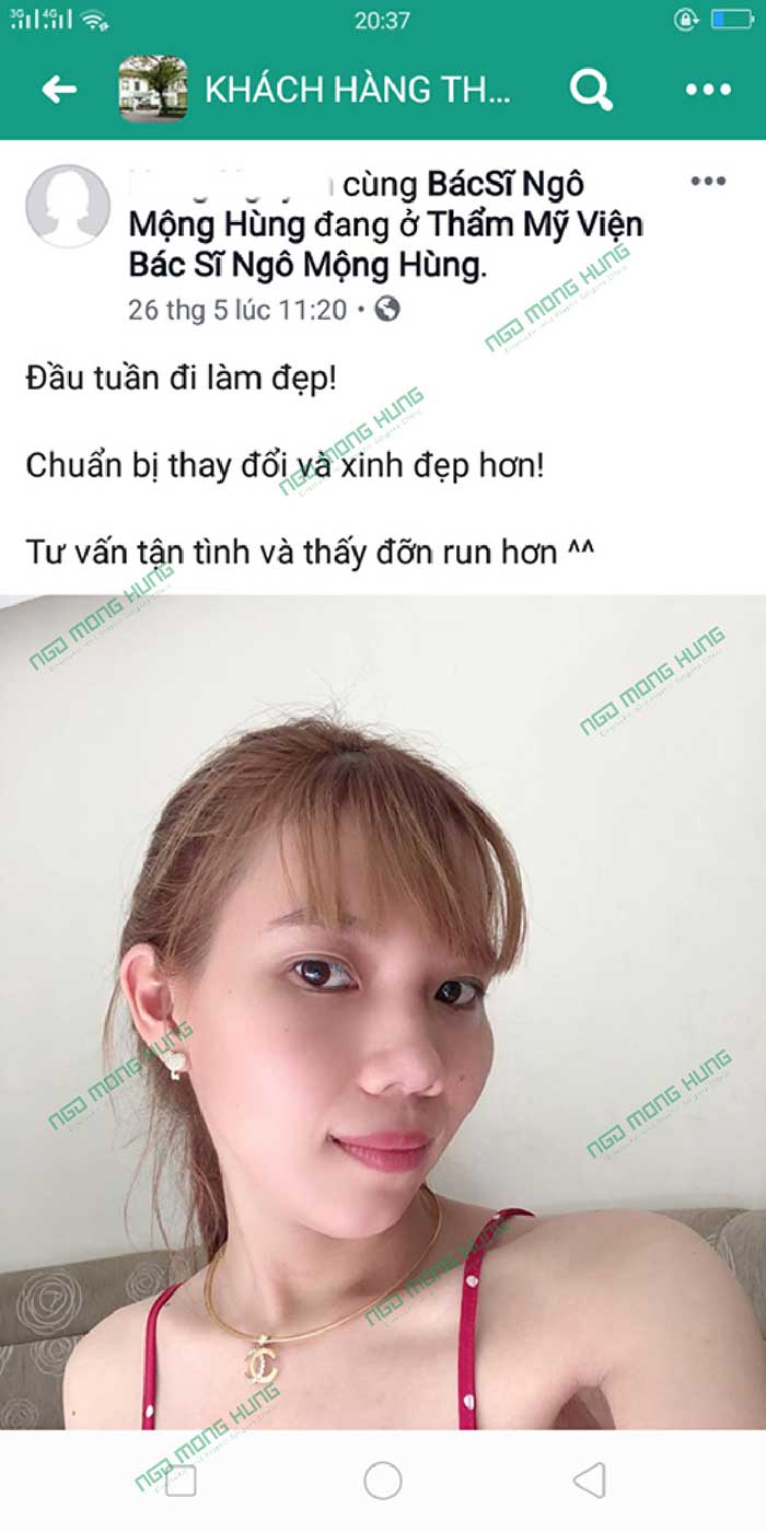 Cây nâng mũi Hàn Quốc