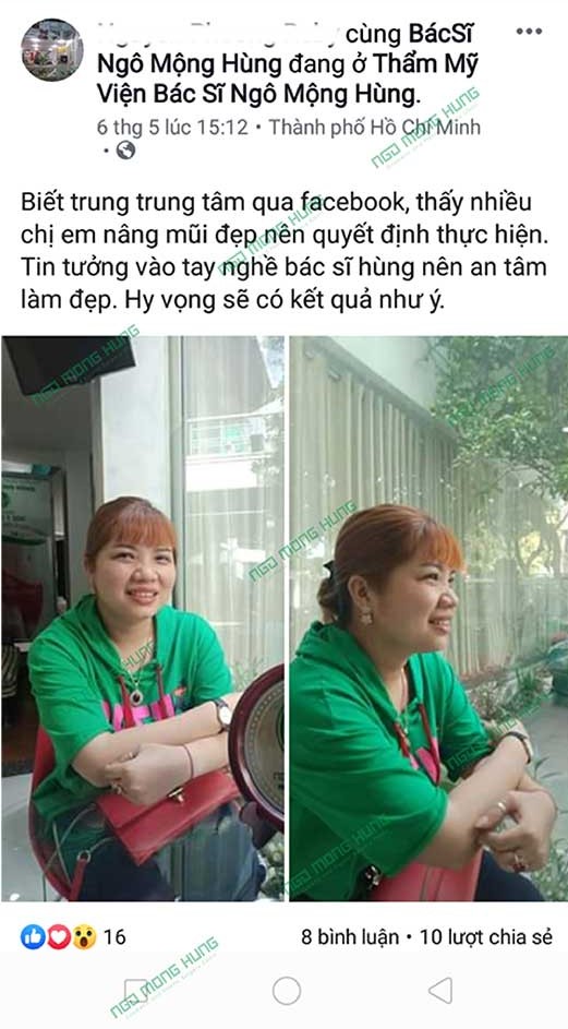Nâng mũi giá rẻ