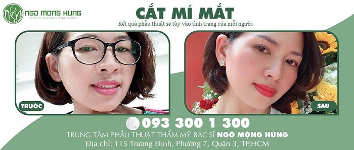 Hành trình trẻ hóa nhan sắc nhờ cắt mí mắt của bà mẹ thành đạt N.T.B.N
