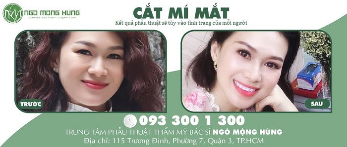 Hóa “hot mom” đẹp hút hồn chỉ nhờ vào 1 lần cắt mí mắt