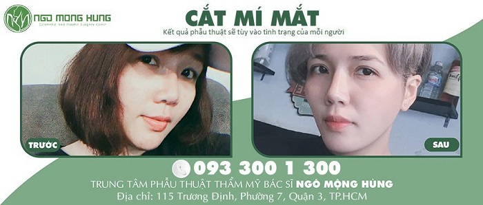 Màn lột xác đầy ấn tượng của cô nàng cá tính nhờ cắt mí mắt