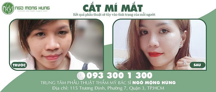Cắt mí mắt: cô gái quê mùa lột xác sang chảnh bất ngờ