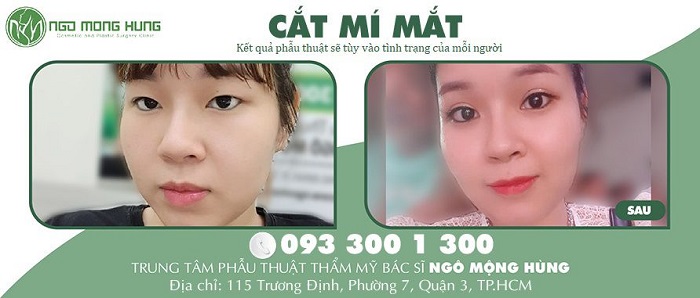4. Phẫu thuật có điểm dừng, cô gái nhận được thành quả xứng đáng sau khi cắt mí mắt 
