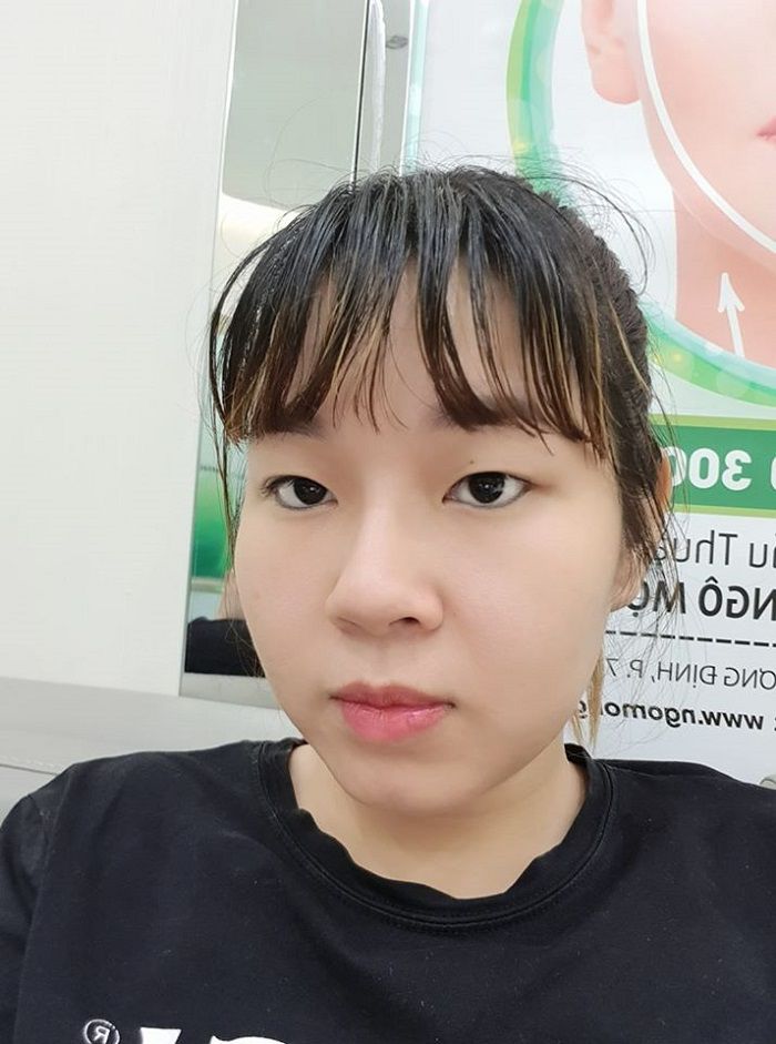 4. Phẫu thuật có điểm dừng, cô gái nhận được thành quả xứng đáng sau khi cắt mí mắt 