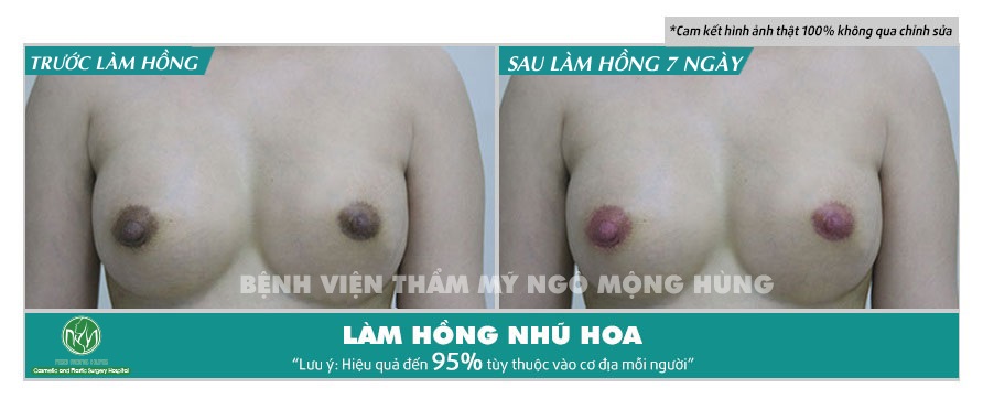 Mẹo làm hồng núm vú