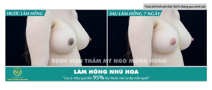 Mẹo làm hồng núm vú