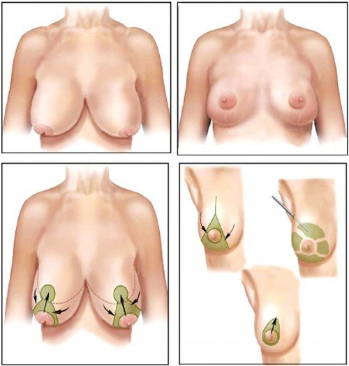 Cách trị ngực chảy xệ