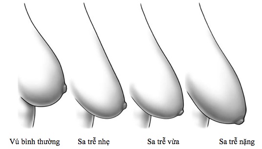 Biểu hiện ngực xệ