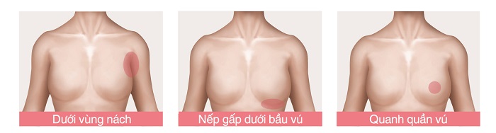 Nâng ngực bao lâu thì mềm 
