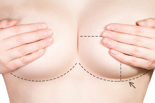 Cách nâng ngực xệ