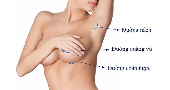 Nâng ngực gel