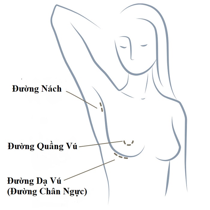 Nâng ngực nội soi mới nhất