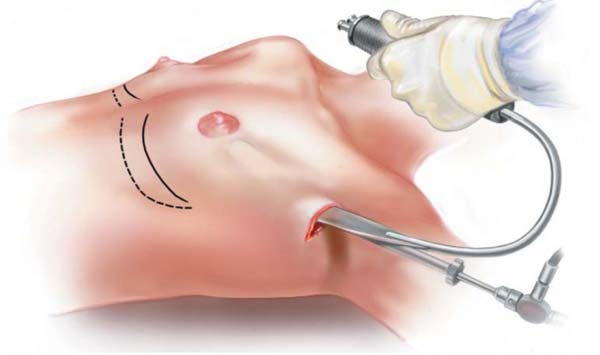 Giá nâng ngực túi giọt nước