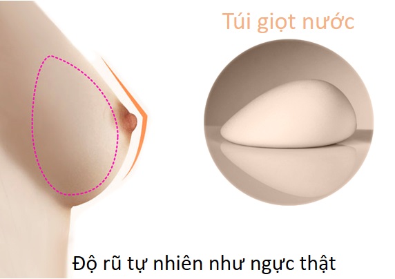 Ngực hình giọt nước là như thế nào
