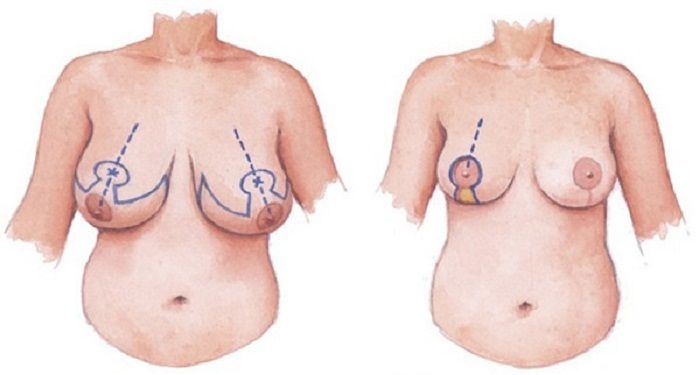 Cách giữ ngực không bị chảy xệ sau khi sinh