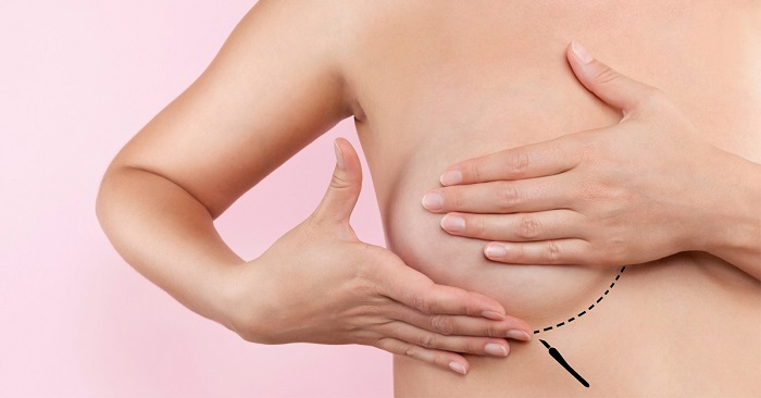 Sau khi nâng ngực 1 tuần