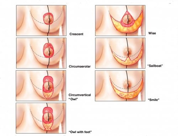 Treo sa trễ đường quầng